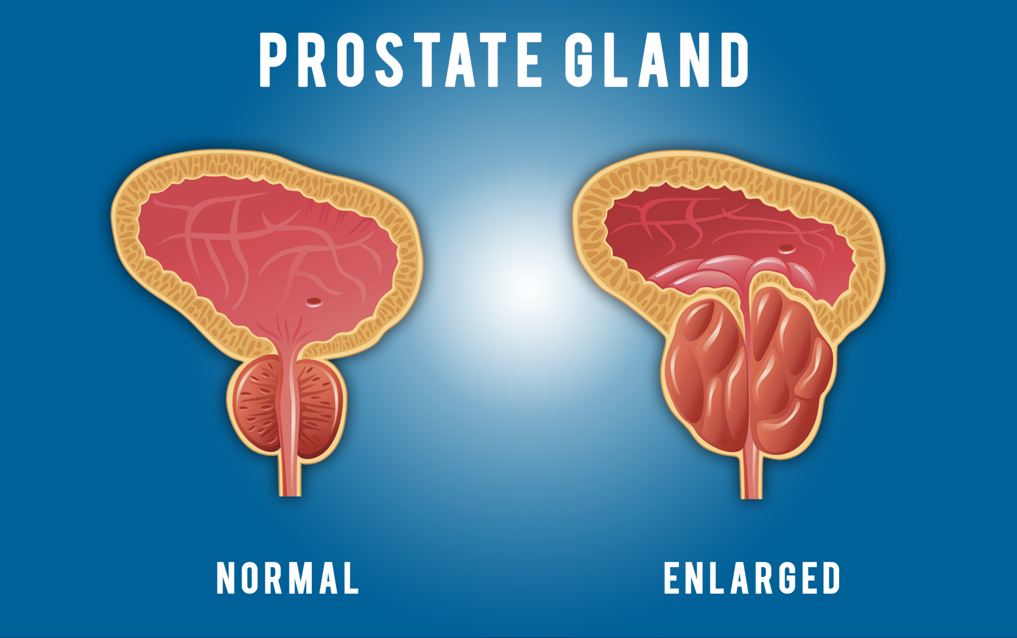 How to Maintain a Healthy Prostate: A Guide for Men
